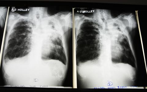 Study Links Smoking to Millions of TB Deaths